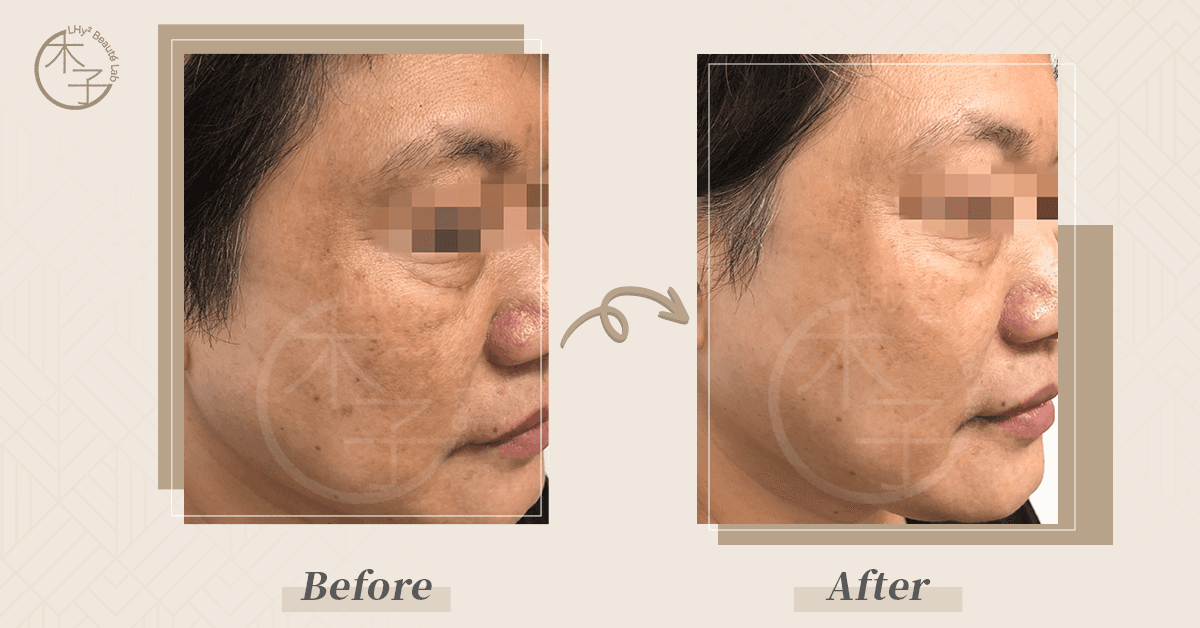 Hollywood Spectra 醫學級去荷爾蒙斑治療 效果對比