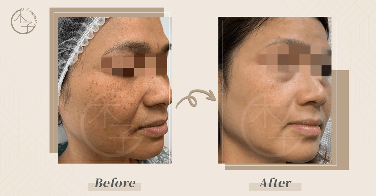 Hollywood Spectra 醫學級去荷爾蒙斑治療 效果對比