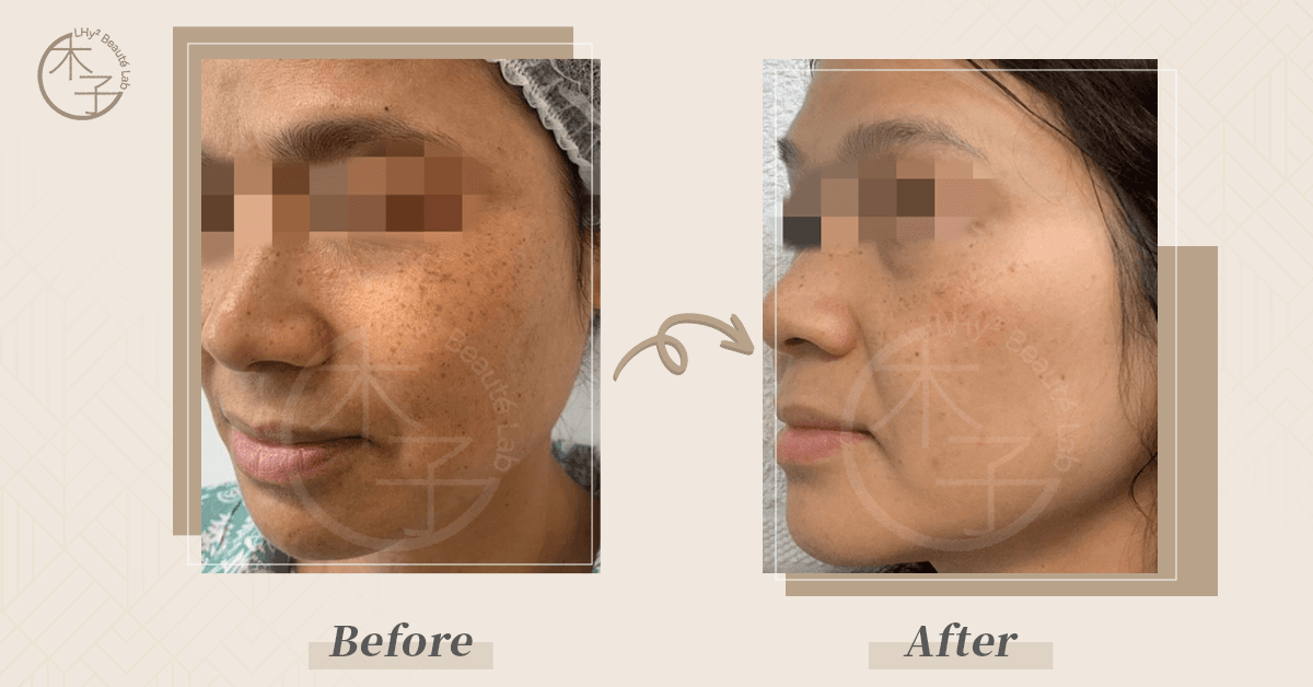 Hollywood Spectra 醫學級去荷爾蒙斑治療 效果對比