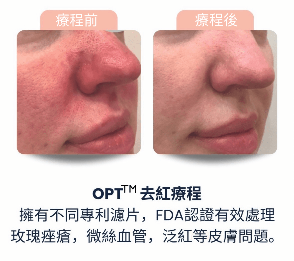 Stellar M22 第8代 AOPT 超光子嫩膚 效果對比