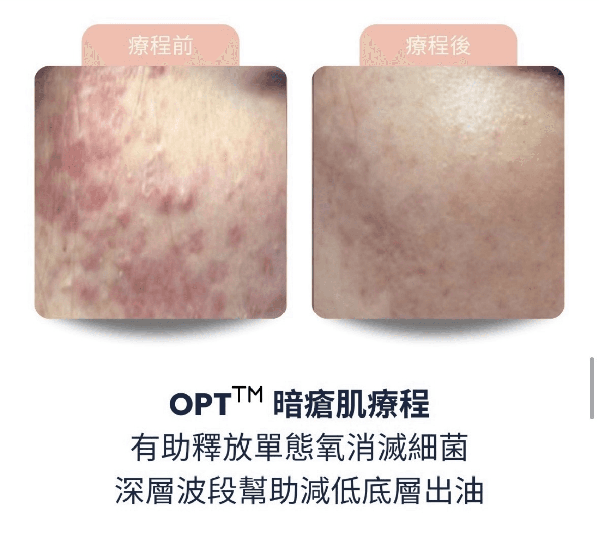 Stellar M22 第8代 AOPT 超光子嫩膚 效果對比