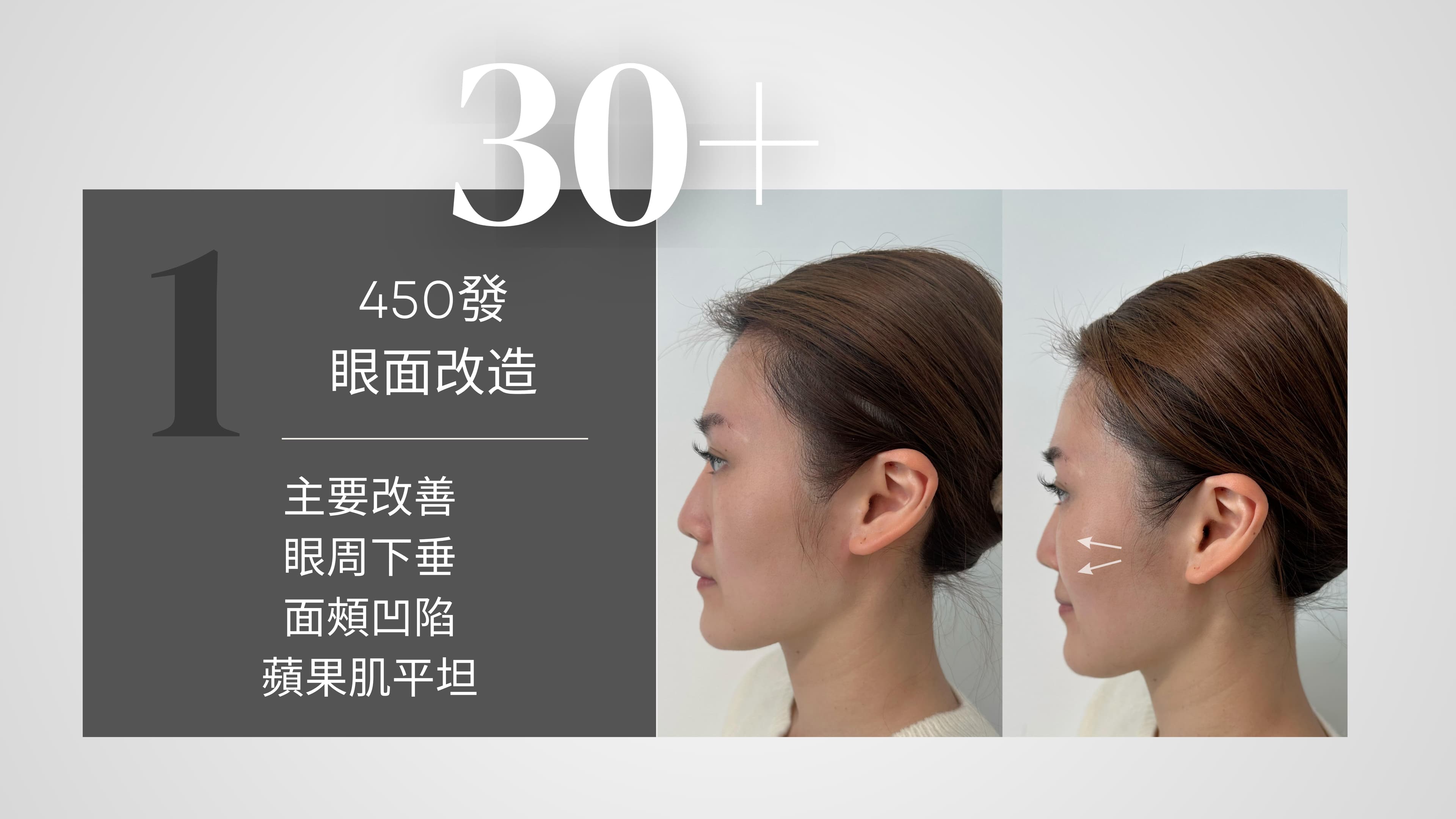 Oligio X 醫美版逆齡緊膚電波拉提 效果對比