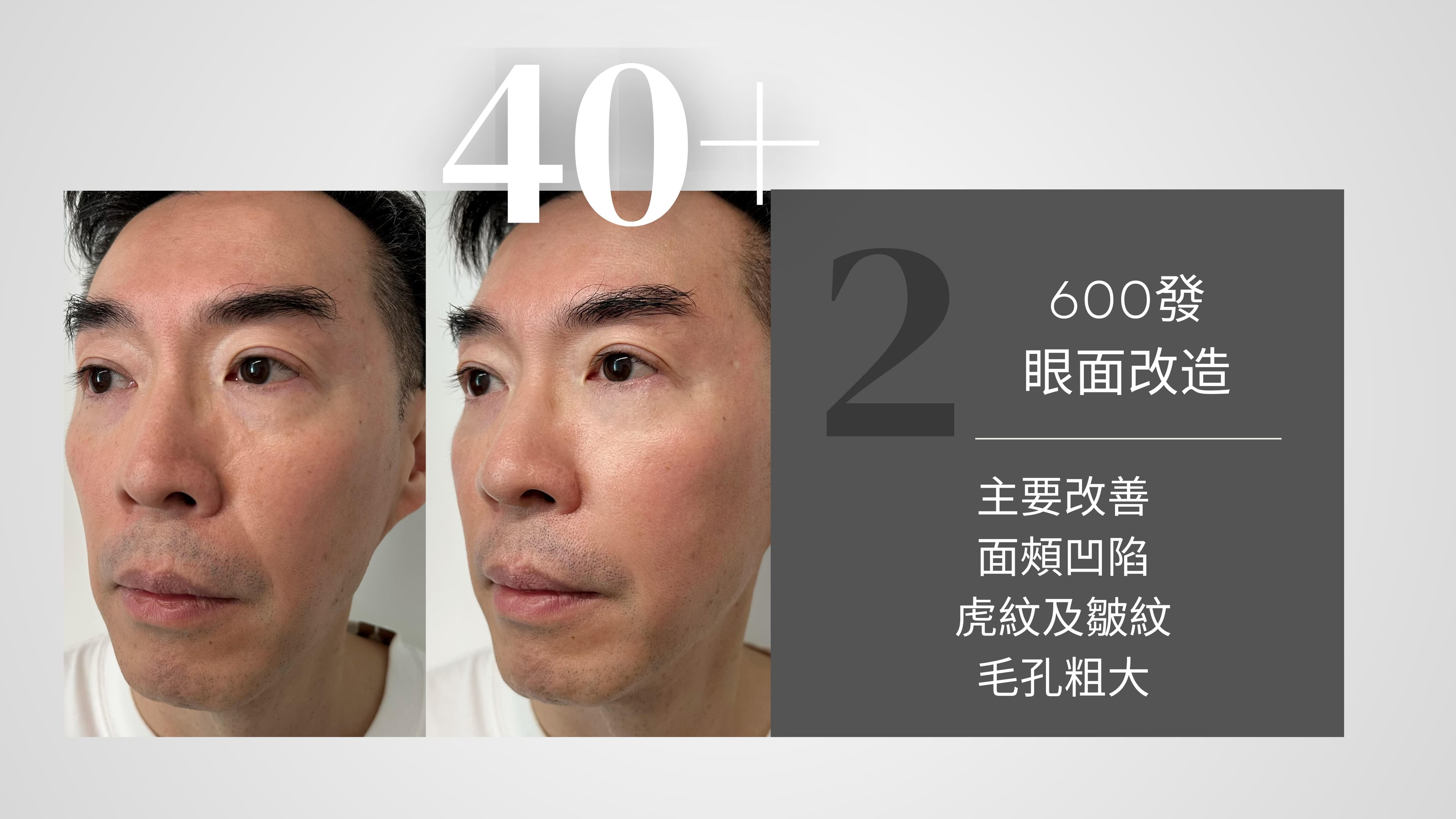 Oligio X 醫美版逆齡緊膚電波拉提 效果對比