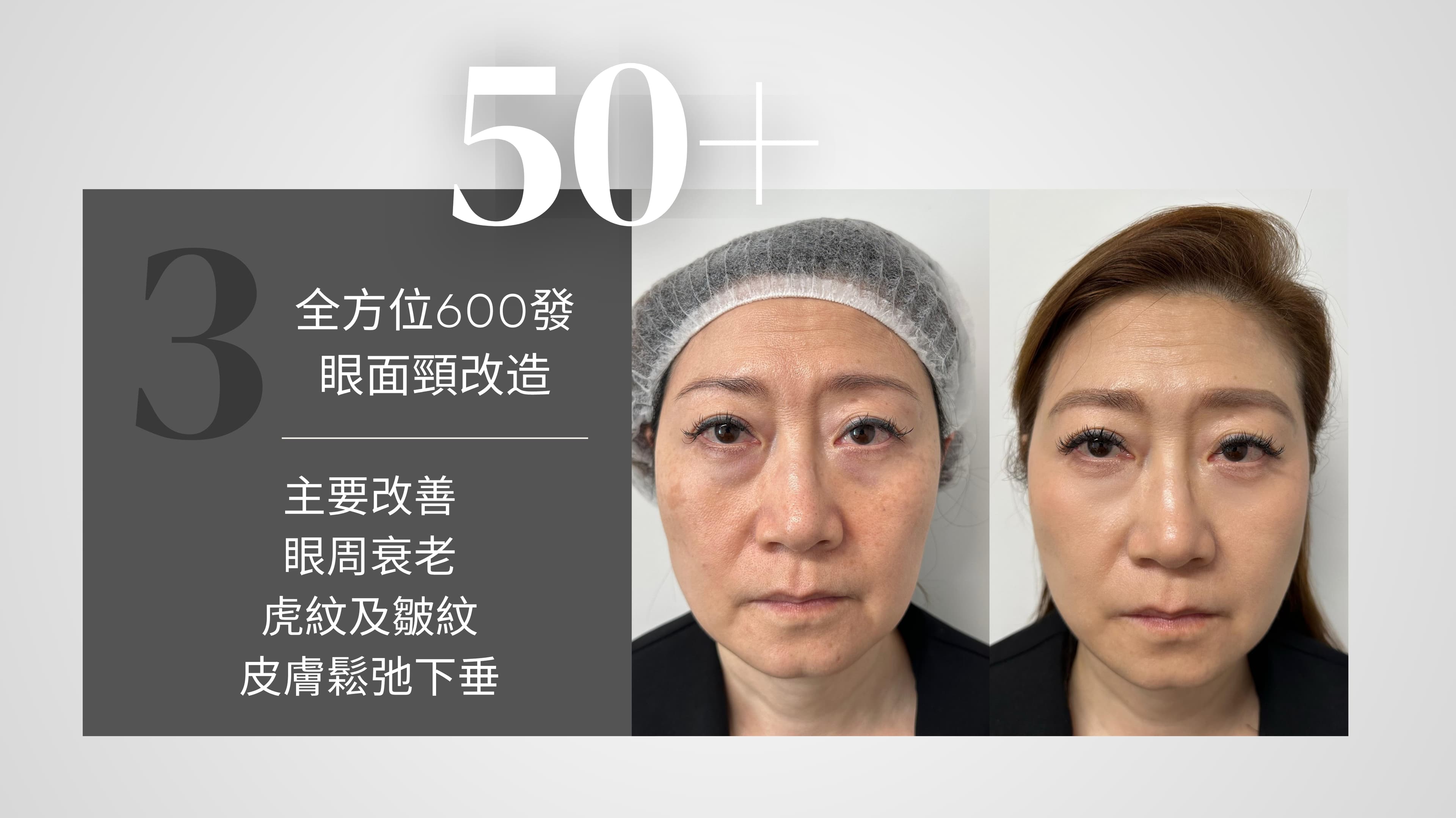 Oligio X 醫美版逆齡緊膚電波拉提 效果對比