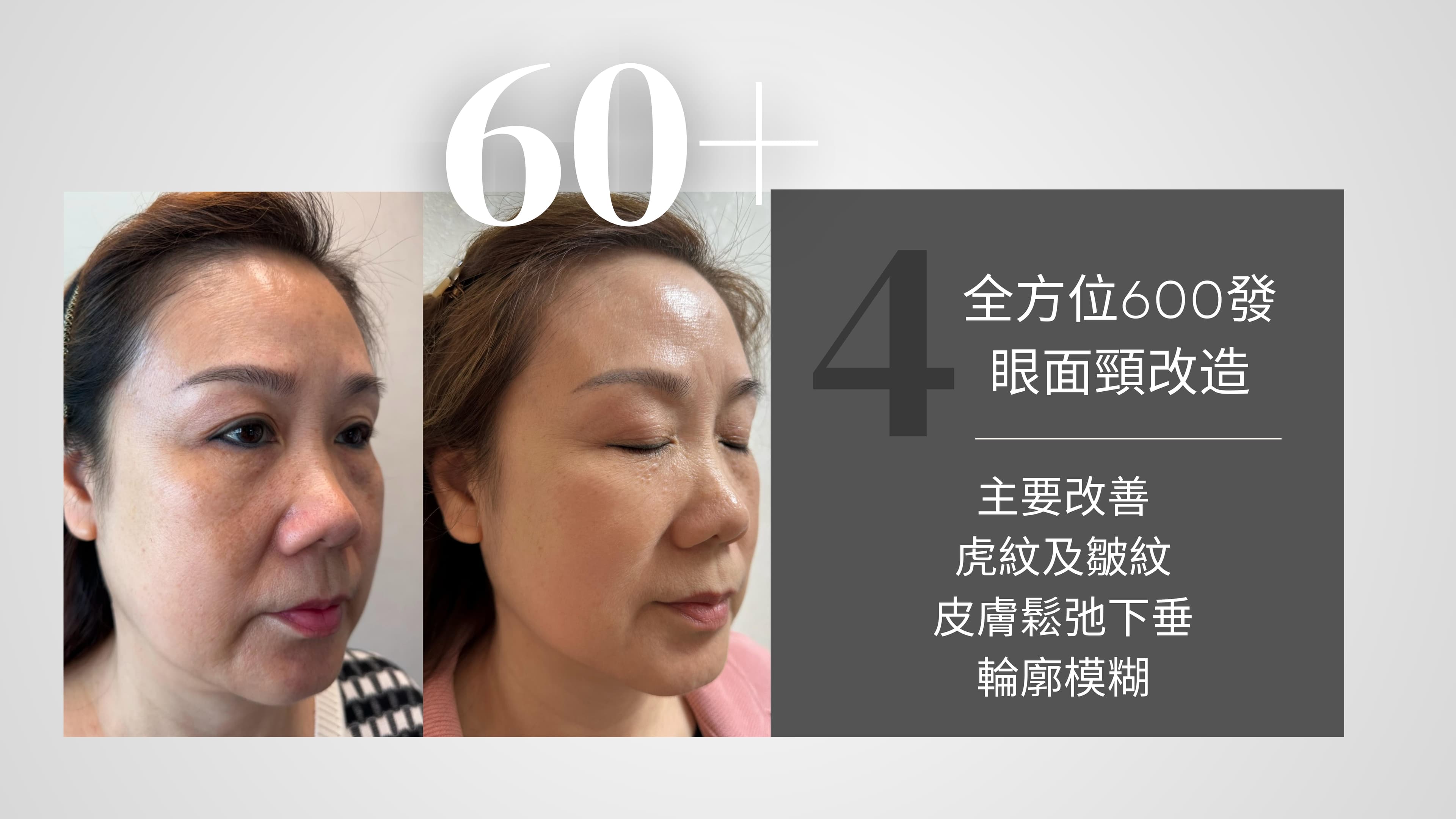 Oligio X 醫美版逆齡緊膚電波拉提 效果對比